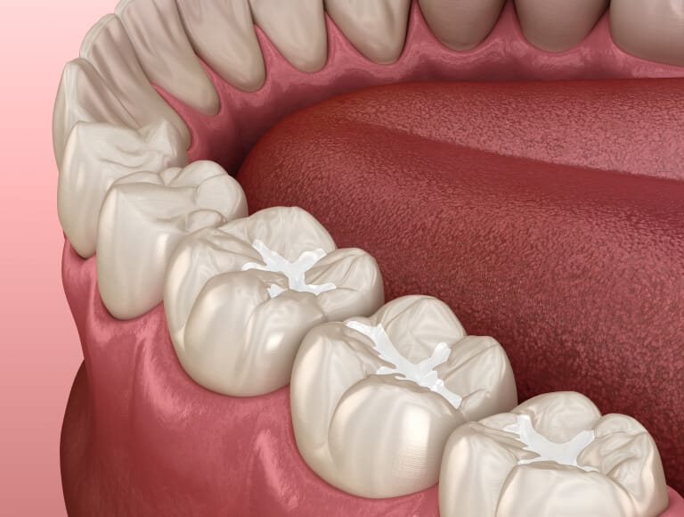Who can benefit from dental sealants — Dentists of SLO San Luis Obispo