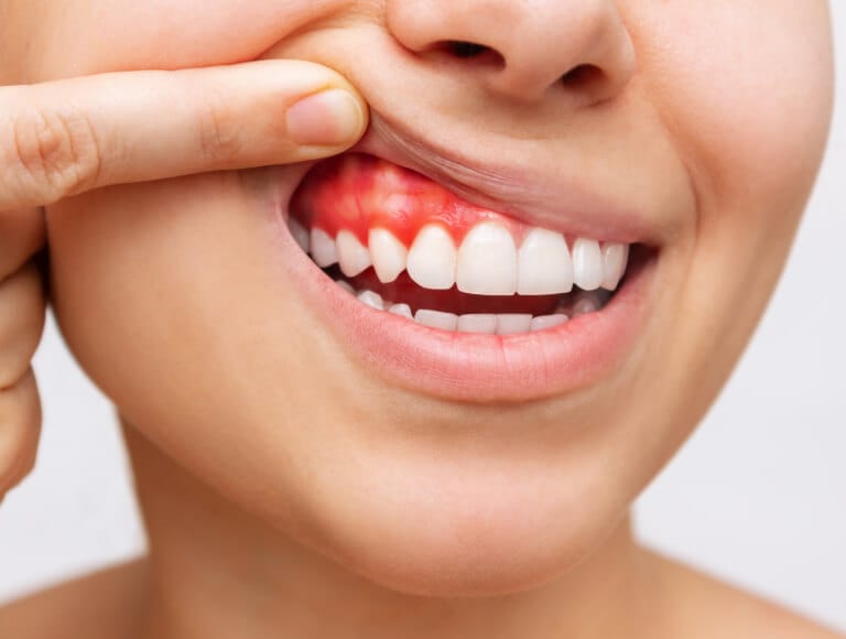 Noticing changes in your gums — Dentists of SLO San Luis Obispo