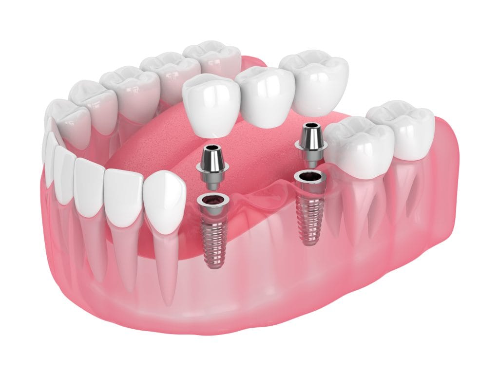 Multiple Missing Teeth
