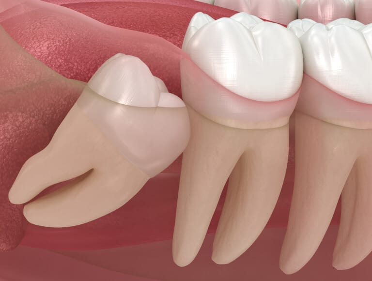 Is it time to remove your wisdom teeth — Dentists of SLO San Luis Obispo